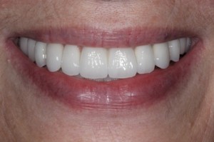Rockville Maryland MD Dental Implants by Dr. Joe Kravitz