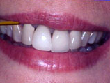Purple swollen gums around dental crowns